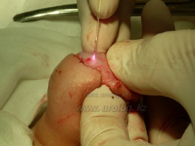 фото обрезание, circumcisio photo