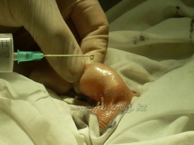 фото обрезание, circumcisio photo