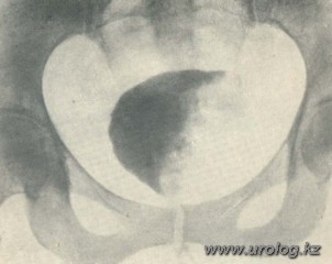 рак мочевого пузыря фото